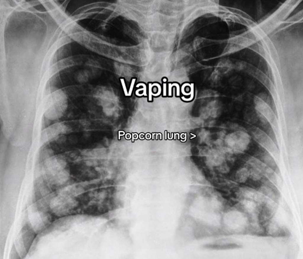 Bronchiolitis obliterans, also known as popcorn lung, is a condition that makes breathing difficult because of damage to small airways in the lungs.